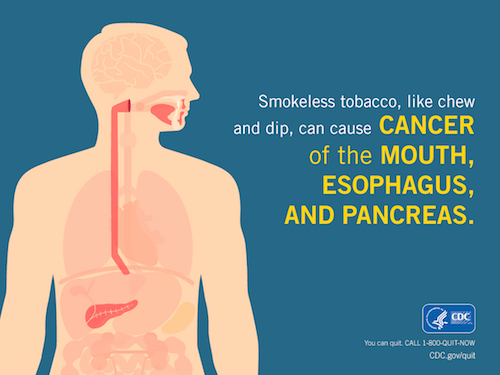 Smokeless tobacco, like chew and dip, can cause cancer of the mouth, esophagus, and pancreas.