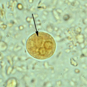 Figure D: Cyst of <em>E. histolytica/E. dispar</em> in a concentrated wet mount stained with iodine. Notice the chromatoid body with blunt, rounded ends (arrow).