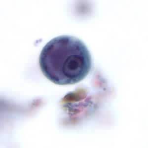 Figure A: Immature cyst of <em>E. histolytica</em>. The specimen was preserved in poly-vinyl alcohol (PVA) and stained with trichrome. PCR was performed on this specimen to differentiate between <em>E. histolytica</em> and <em>E. dispar</em>