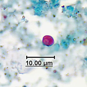 Figure D: Fungal element in an acid-fast stained stool specimen. Such objects may be confused for the oocysts of <em>Cryptosporidium</em> spp. Images courtesy of the Georgia State Public Health Laboratory.