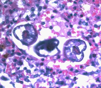 Figure A: L3 larvae of <em>A. lumbricoides</em> in lung tissue, stained with H&E. Image taken at 400x magnification.