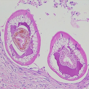 Figure A: Cross-sections of larvae of <em>D. renale</em> in a subcutaneous nodule, stained with hematoxylin and eosin (H&E). Images courtesy of the Laboratory of Parasitology, National Public Health Research Center in Vilnius, Lithuania