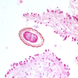 Figure B: Egg of <em>D. renale</em> in the kidney of a mink, stained with hematoxylin and eosin (H&E).