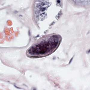 Figure E: Egg of <em>E. vermicularis</em> in a colon biopsy specimen, stained with H&E.