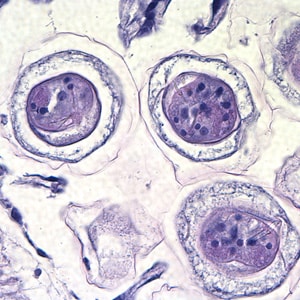 Figure C: Higher magnification of the eggs in Figures A and B, taken at 1000x, oil. Hooks do not stain with H&E but are refractile and may be visible in stained specimens with proper adjustment of the microscope. Polar filaments are visible in the egg in the upper right quadrant of the image.