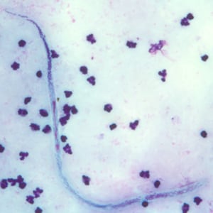 Figure C: Microfilaria of <em>W. bancrofti</em> in a thick blood smear, stained with Giemsa.