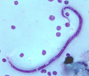 Figure A: Microfilaria of <em>B. timori</em> in a thick blood smear from a patient from Indonesia, stained with Giemsa and captured at 500x oil magnification. Image from a specimen courtesy of Dr. Thomas C. Orihel, Tulane University, New Orleans, LA.