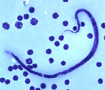 Figure C: Microfilaria of <em>B. timori</em> in a thick blood smear from a patient from Indonesia, stained with Giemsa and captured at 500x oil magnification. Image from a specimen courtesy of Dr. Thomas C. Orihel, Tulane University, New Orleans, LA.