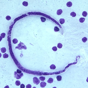 Figure D: Microfilaria of <em>B. timori</em> in a thick blood smear from a patient from Indonesia, stained with Giemsa and captured at 500x oil magnification. Image from a specimen courtesy of Dr. Thomas C. Orihel, Tulane University, New Orleans, LA.