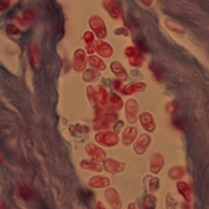 Figure D: Microsporidia spores from a corneal section, stained with trichrome.