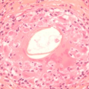 Figure B: Longitudinal section of an egg of <em>P. kellicotti</em> in a lung biopsy specimen, stained with hematoxylin and eosin (H&E). Image courtesy of Dr. Gary Procop.