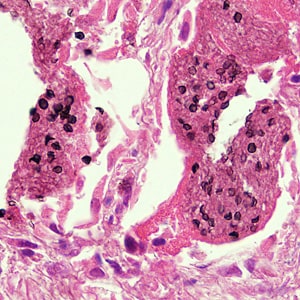 Figure B: Cysts of <em>P. jirovecii</em> in lung tissue, stained with methenamine silver and hematoxylin and eosin (H&E). The walls of the cysts are stained black; the intracystic bodies are not visible with this stain.