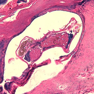 Figure A: <em>Sarcoptes scabiei</em> mite in a skin biopsy, stained with H&E.