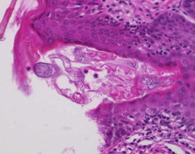 Figure C: Cross-sections of skin showing <em>Demodex</em> mite, stained with hematoxylin and eosin (H&E). Images courtesy of the Westchester Medical Center, Valhalla, NY.