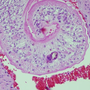 Figure D: Adults of <em>Schistosoma</em> spp. in lung tissue, stained with H&E. Images courtesy of Harvard Medical School, Cambridge, MA.