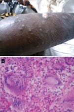 Thumbnail of A 36-year-old HIV-infected woman with Mycobacterium avium disease. A) Photograph of skin lesions on right leg, taken before treatment. B) Histopathologic appearance of skin biopsy specimen from right leg lesion (stain, hematoxylin and eosin; magnification ×40).