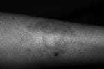 Thumbnail of Skin lesion of patient 3, a solitary patch on the left leg with erythematous papules on the border.