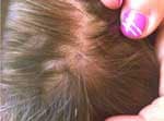 Thumbnail of Residual alopecia 10 weeks after tick bite in 13-year-old boy with scalp eschar and neck lymphadenopathy caused by Rickettsia massiliae. Printed with permission from N.C. (photographer and author) and from parents of the patient. 
