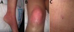 Retrospectively identified early autochthonous case of Crimean-Congo hemorrhagic fever in a woman in Spain, 2013. A, B) Erythema in the patient’s ankle (A) and knee (B) 3 days after a tick bite during a leisure walk. C) Necrotic lesion on patient’s back at site of tick bite. 