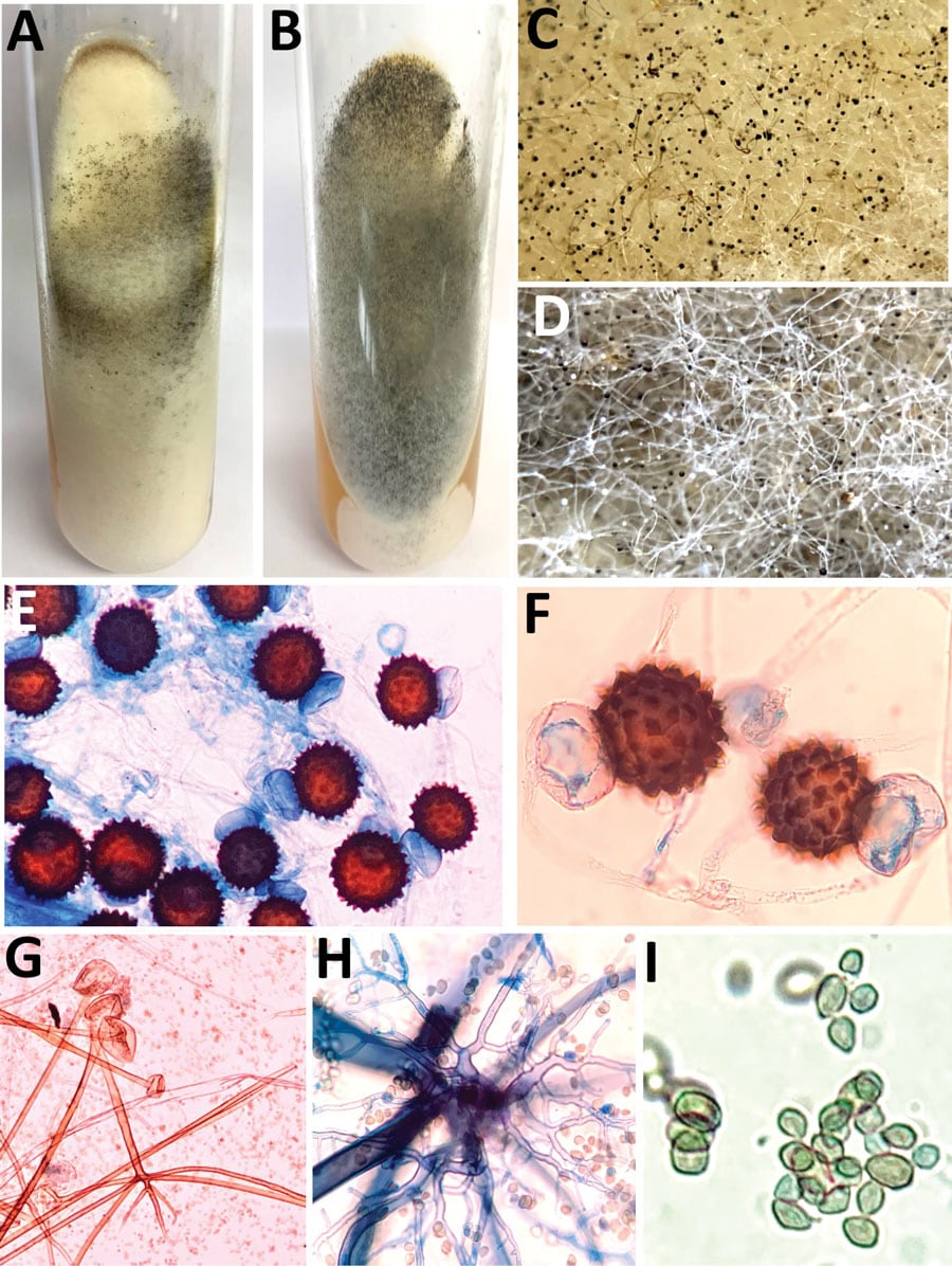 Macroscopic and microscopic characteristics of Rhizopus arrhizus and R. homothallicus isolated from tissue samples from patients enrolled in a 10-month retrospective study, Chandigarh, India, January–October 2021. A, B) Macroscopic appearance of colonies of R. homothallicus (A) and R. arrhizus (B) fungi. C, D) Macro lens image of the colonies showing dark-brown specks in R. homothallicus (C) and black and white dots (salt and pepper appearance) in R. arrhizus (D). E) Photomicrograph from a lactophenol cotton blue mount of R. homothallicus showing multiple reddish brown ornamented zygospores (original magnification ×400). F) Magnified image of E showing unequal suspenser cells and zygospore with prominent spinous projections. G) R. arrhizus showing long, unbranched sporangiophore with nodal rhizoids (original magnification ×200). H) Magnified image of extensively branched rhizoid seen in R. arrhizus. I) Magnified image of sporangiospores of R. arrhizus. 