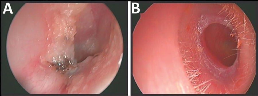 Right ears of 2 patients with chronic ear infections who were infected with Auritidibacter ignavus, Germany. A) Patient 1. Auditory canal was swollen and red and contained fungal spores. B) Patient 2. Fibrotic stenosis in the cartilaginous part of the ear canal, which was suggestive of a postinflammatory acquired atresia of the external auditory canal.