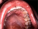 This HIV-positive patient was exhibiting signs of a secondary condyloma acuminata infection, i.e., venereal warts (This intraoral eruption of condyloma acuminata, or venereal warts was caused by the human papilloma virus).