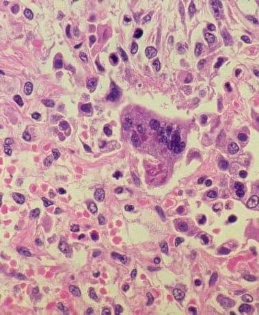 Measles virus under a microscope and histopathology of measles pneumonia