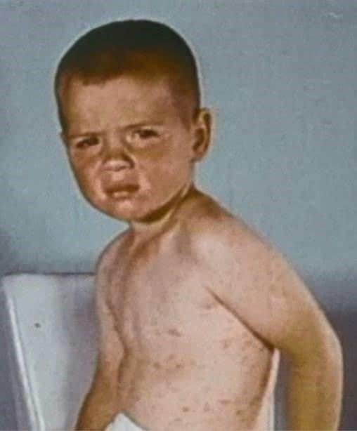 Un niño con sarpullido en la parte superior del cuerpo por el sarampión