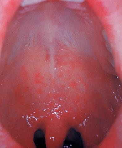 Close-up of the inside of the mouth of a patient with Koplik spots from measles