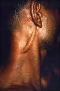 A patient diagnosed with Hansen’s disease, or leprosy, which is caused by the bacterium Mycobacterium leprae and is reportable in many states.