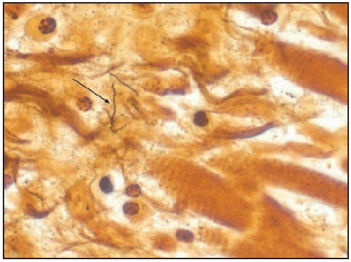 The figure above shows a Warthin-Starry stain of cardiac tissue  demonstrating Borrelia burgdorferi spirochetes in one of three patients whose death was associated with Lyme carditis during November 12–July 2013.