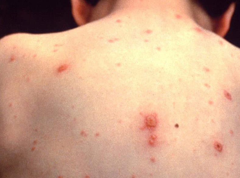 A person's back with a chickenpox rash.