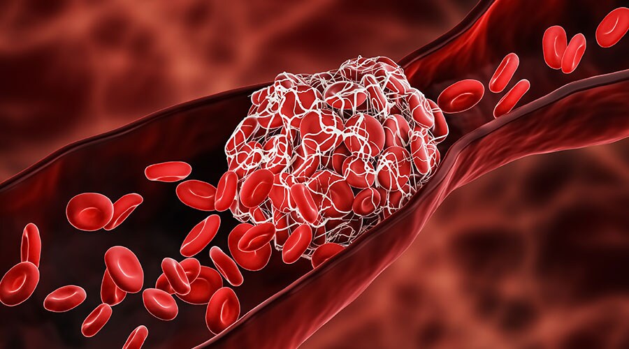 Illustration of a blood clot blocking blood cells in a vein