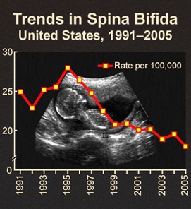 spina bifida babies