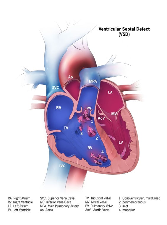CDC Congenital Heart Defects, Ventricular Septal Defect