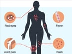 thumbnail of graphic showing symptoms of zika