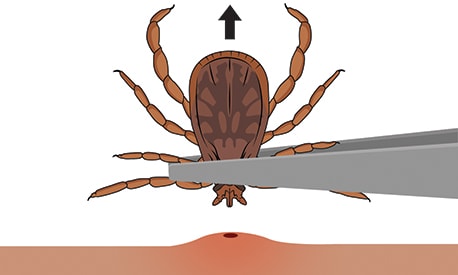 Clip art image of a tick being pulled from skin by a pair of tweezers.