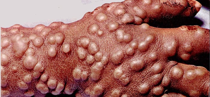 The pustule covered hand of a baby with a mild case of smallpox. 