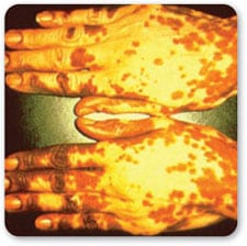 Vista superior de dos manos juntas mostrando %26aacute;reas con p%26eacute;rdida de pigmentaci%26oacute;n