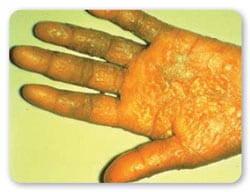 Vista de palma de la mano mostrando corrosi%26oacute;n en la piel y ampollas