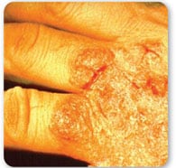 Vista superior del dorso de una mano mostrando irritaci%26oacute;n grave y grietas en la piel