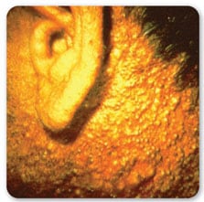 Vista lateral de la oreja y el cuello de una persona mostrando un caso grave de cloracn%26eacute;
