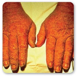 Vista superior del dorso de dos manos mostrando efectos de sensibilizaci%26oacute;n