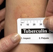 TB skin test kit