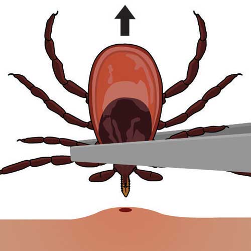 Illustration of a tick being removed from skin by tweezers