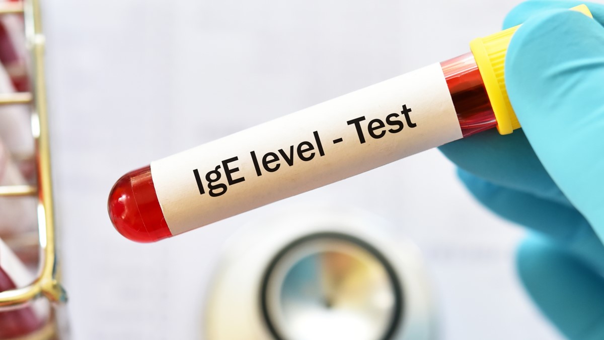 IgE blood test will assist with diagnosis of alpha-gal syndrome.