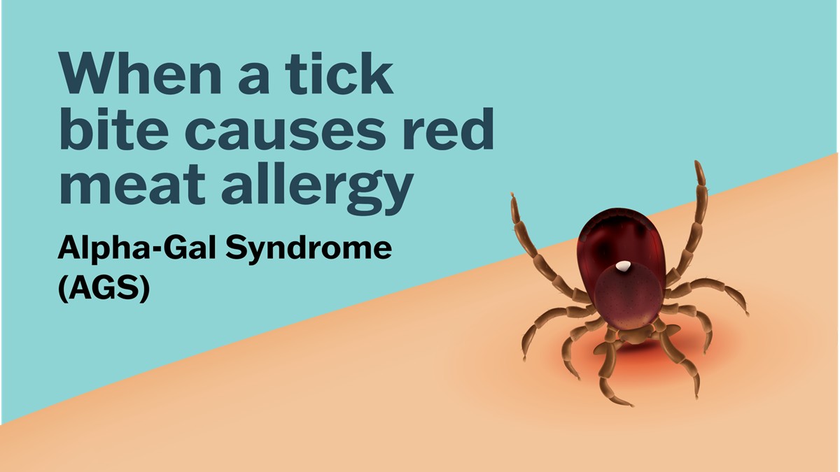 Tick bites can cause an allergic reaction to red meat, diary, and other products.