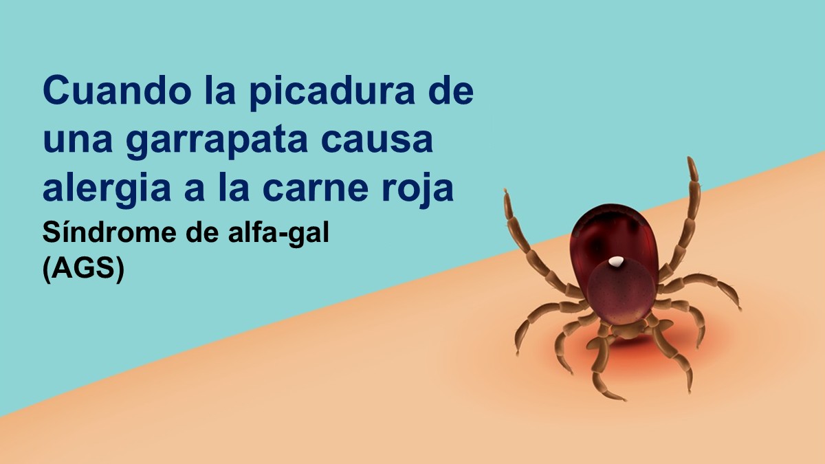 Gráfica de una garrapata picando a una persona con texto superpuesto acerca del síndrome de alfa-gal.