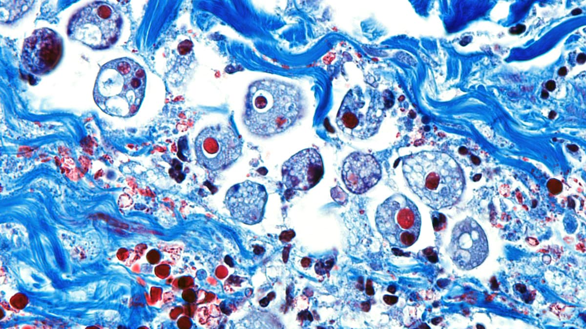 High resolution of Entamoeba histolytica amebas in a person's small intestine.