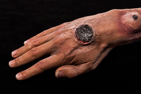Photo of cutaneous anthrax infection on a person's hand showing the telltale black sores of anthrax infection.